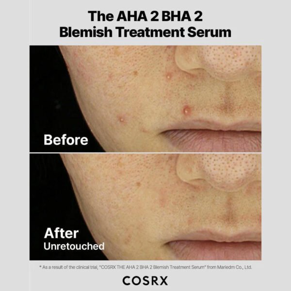 The AHA 2 BHA 2 Blemish Treatment Serum