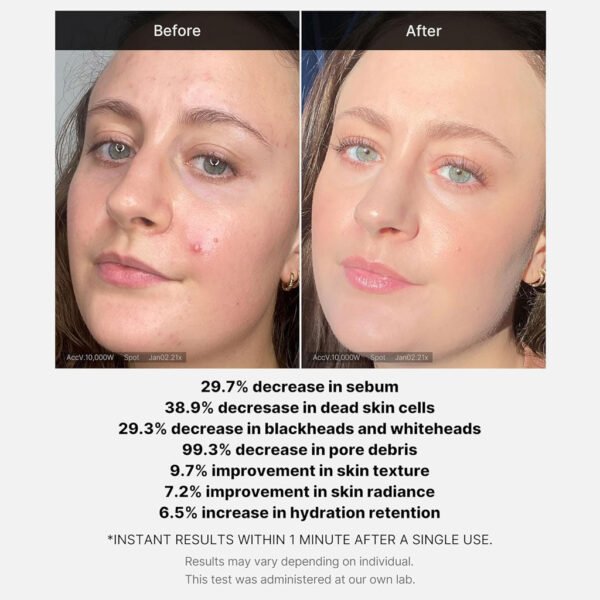 Red Acne Succinic Acid Peel (40g)