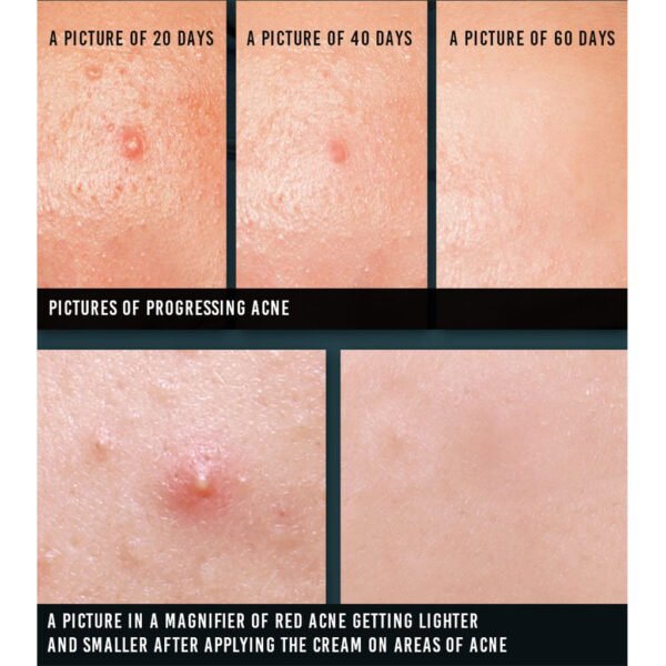 Acne Spot Cream (15ml)